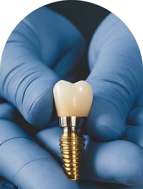 Dental Implants