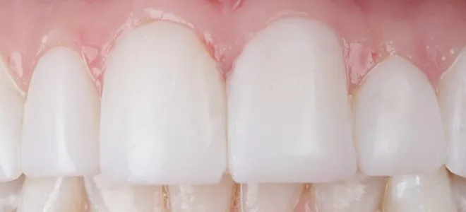 1 After Teeth whitening