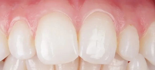 1 Before Teeth whitening