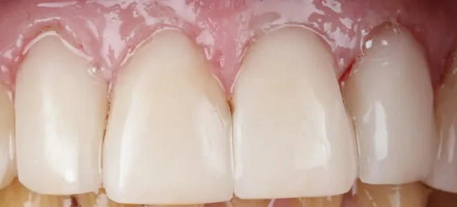 2 After teeh whitening