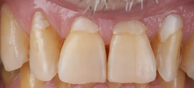 2 Before Teeth whitening
