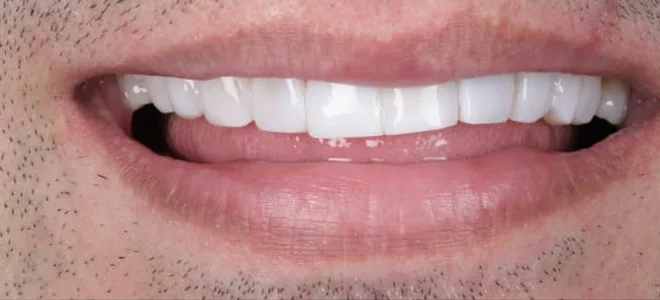 3 After teeth