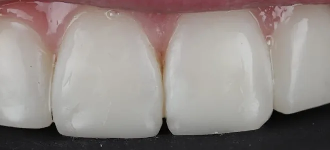 4 After Teeth whitening