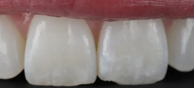 4 Before dental care