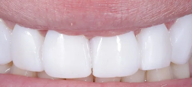 5 After Teeth whitening