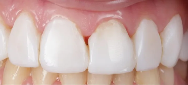 5 Before Teeth whitening