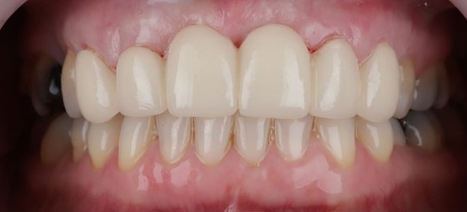 After Dental implant