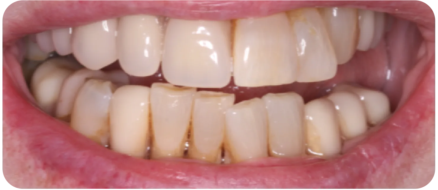 Dentures After dental implant after