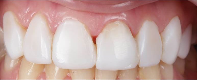 gap between teeth