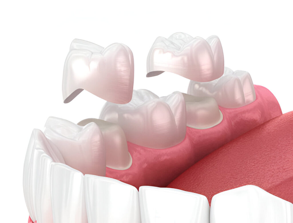 Dental Crowns Dentist in Kendal