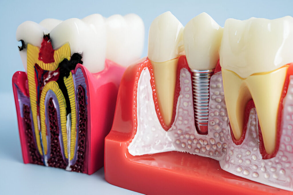 Dental Implants