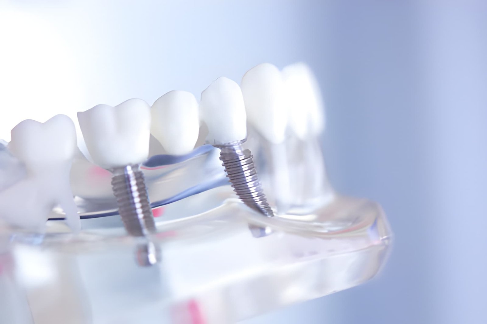 Dental Implants