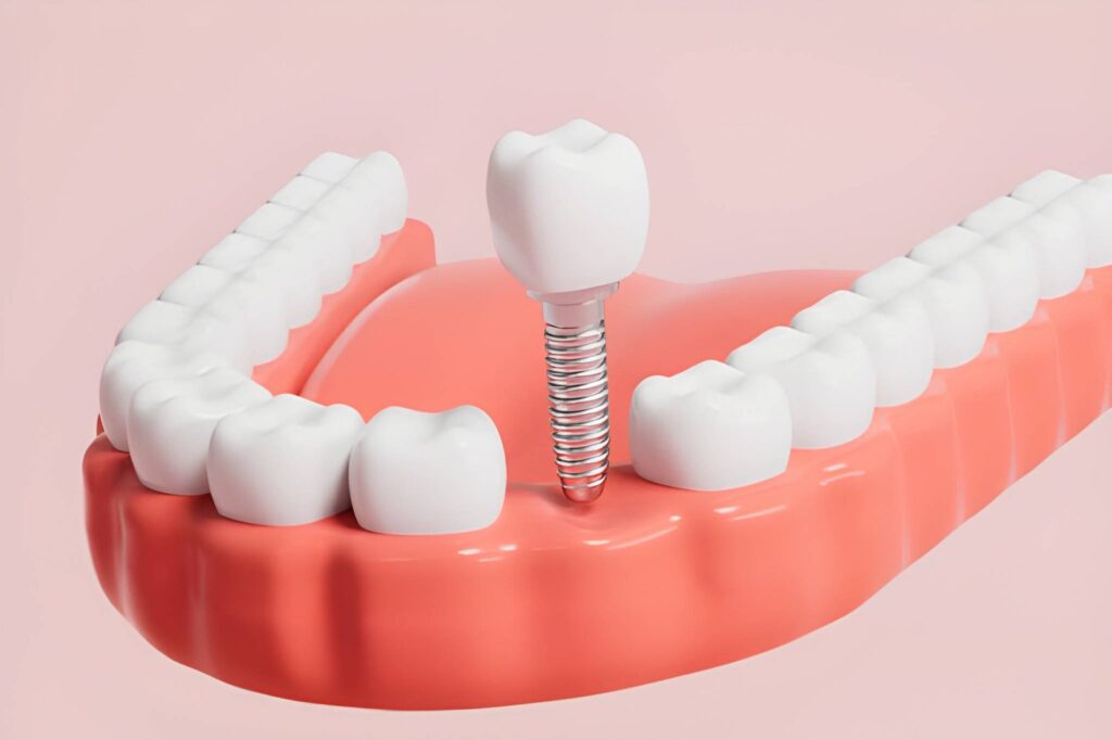 Dental Implants
