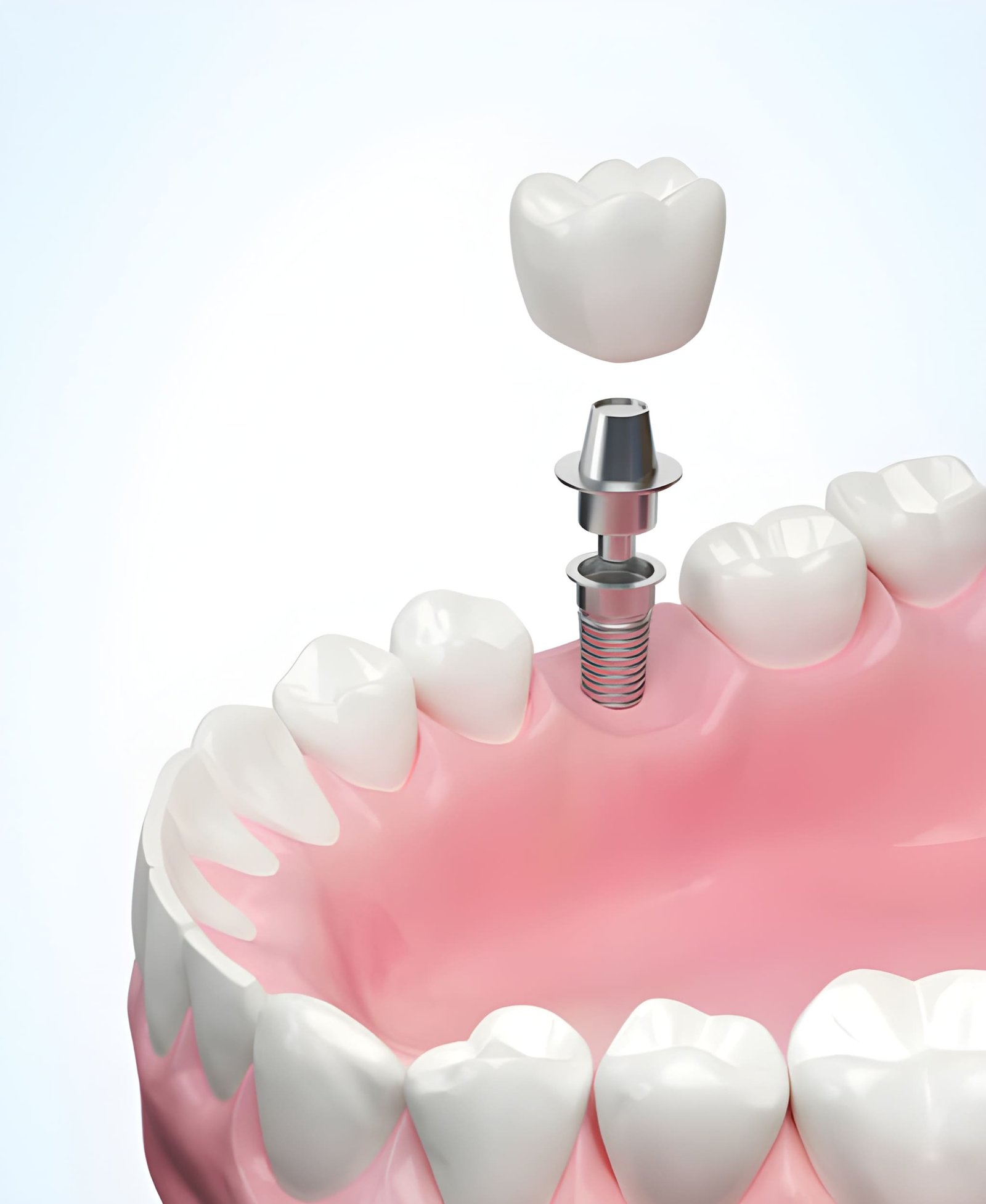 Dental Implants