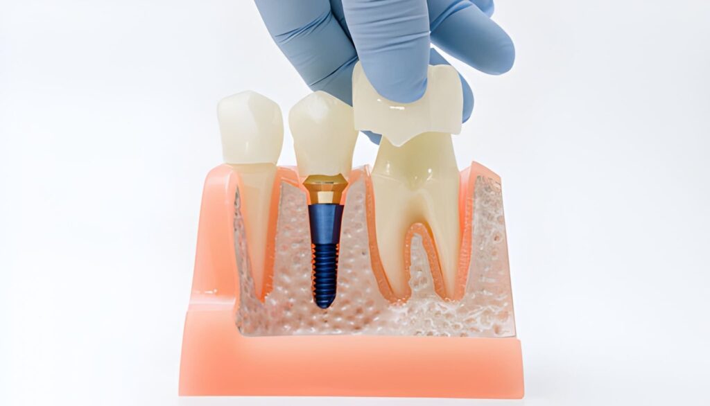 Dental implants in Kendal