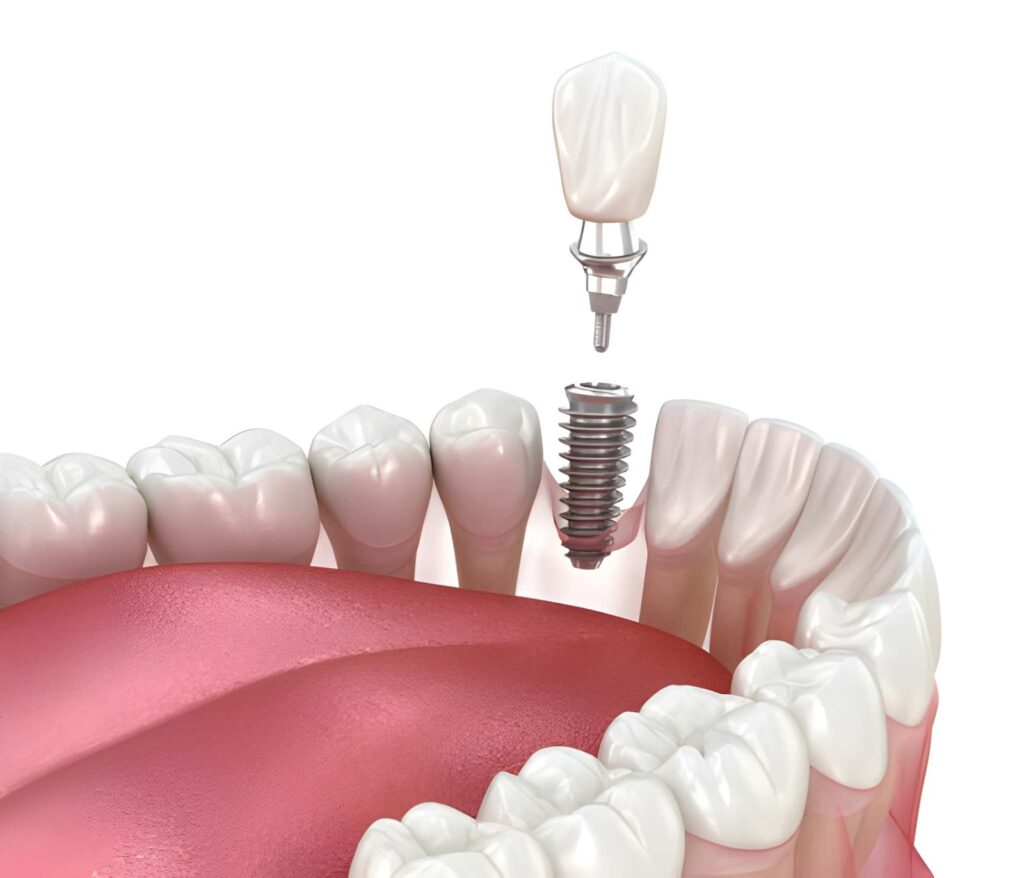 Dental implants in Kendal