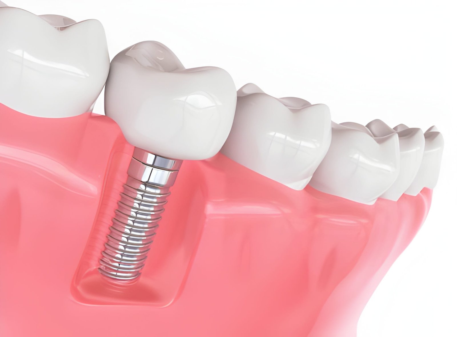 Dental Implants in Kendal