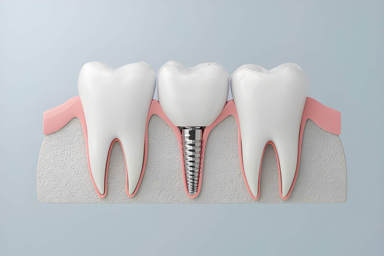 Dental Implants