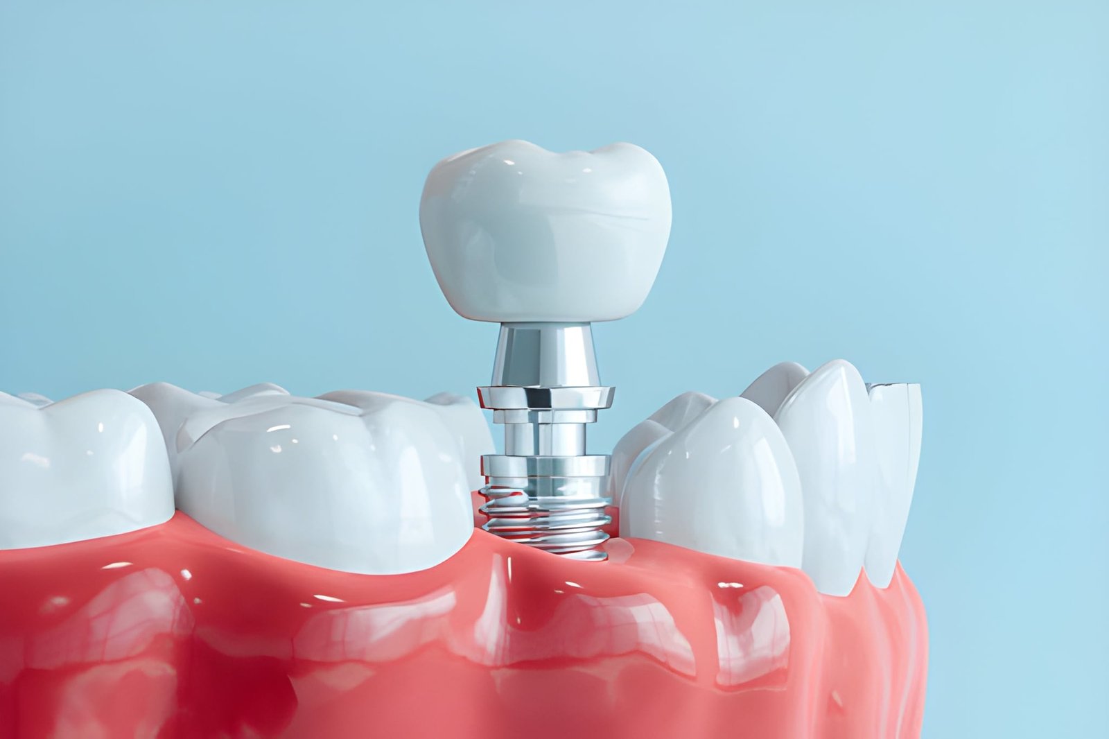 Dental implants
