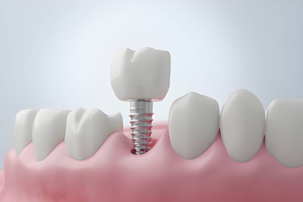 dental implants in kendal