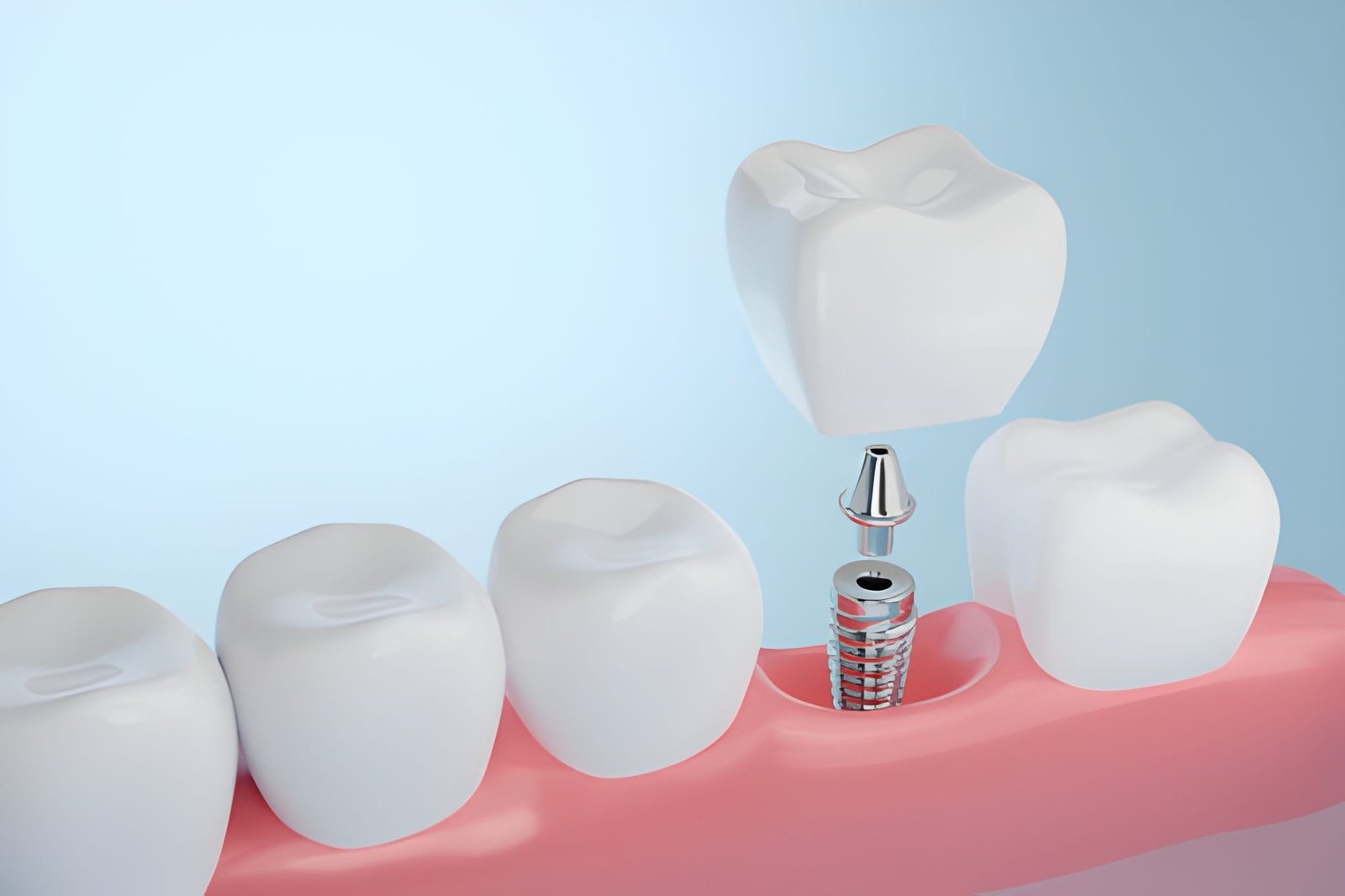 Rule for Implants