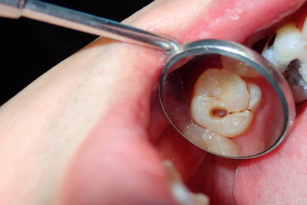 dental filling