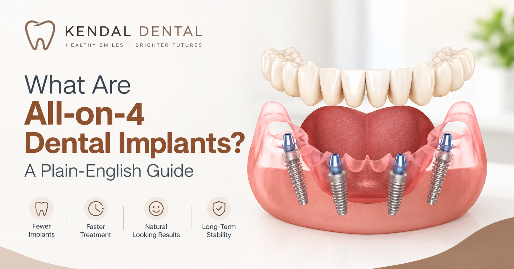 All-on-4 Dental Implants